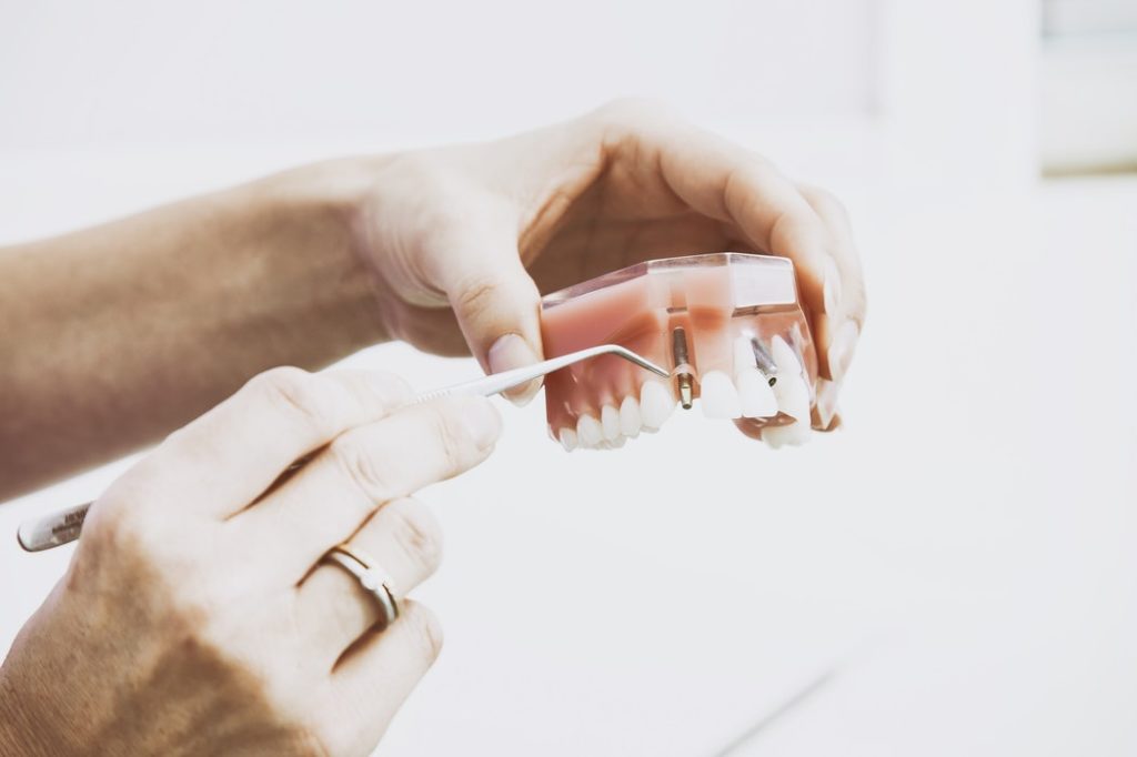 implants dentals