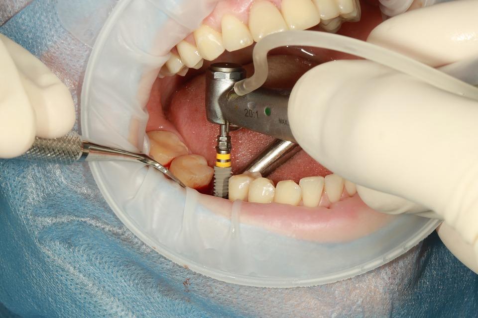tipos de implantes dentales manresa