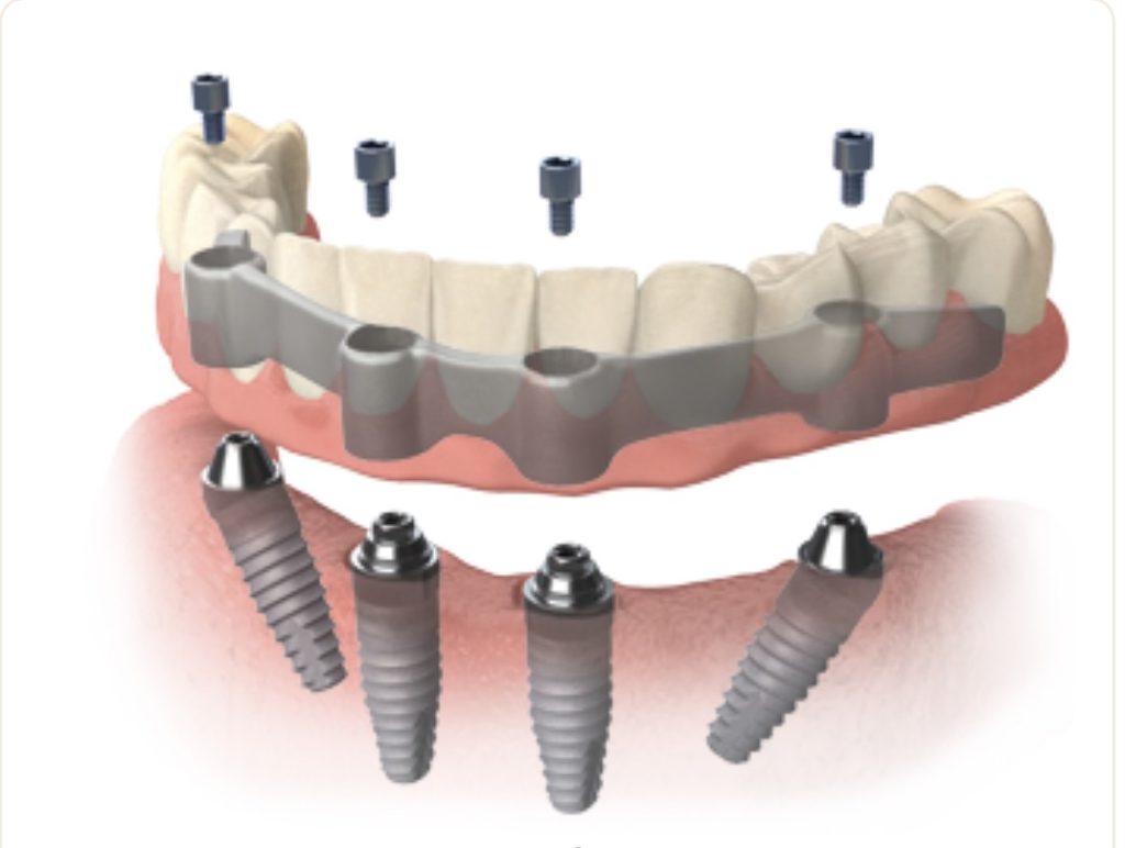 Prótesis dentales implante